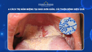 trị nấm miệng tại nhà