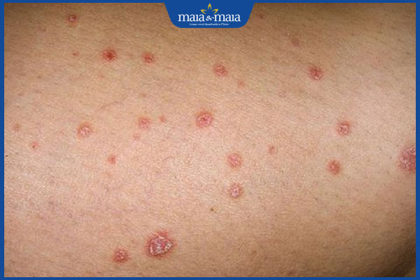 Tổng hợp hình ảnh nấm Candida để nhận biết bệnh nhanh chóng 6 viêm đỏ da do nấm candida