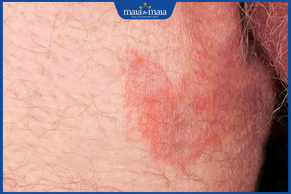 vùng bẹn nhiễm nấm