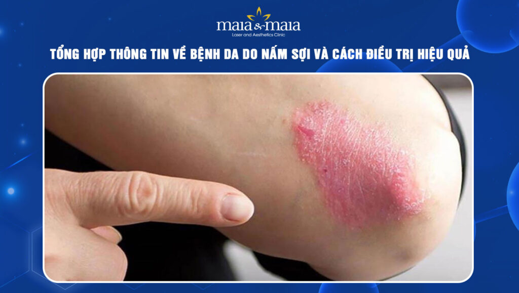 Tổng hợp thông tin về bệnh da do nấm sợi và cách điều trị 1 bệnh da do nấm sợi