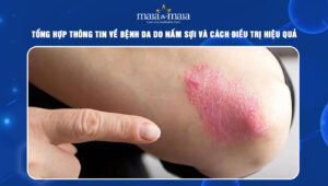 bệnh da do nấm sợi