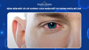 bệnh nấm mắt có lây không