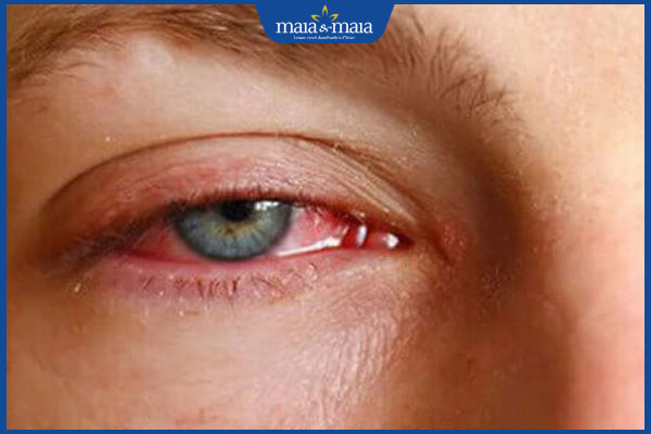 Bị nấm mắt có nguy hiểm không? Biện pháp phòng ngừa 3 cộm mắt