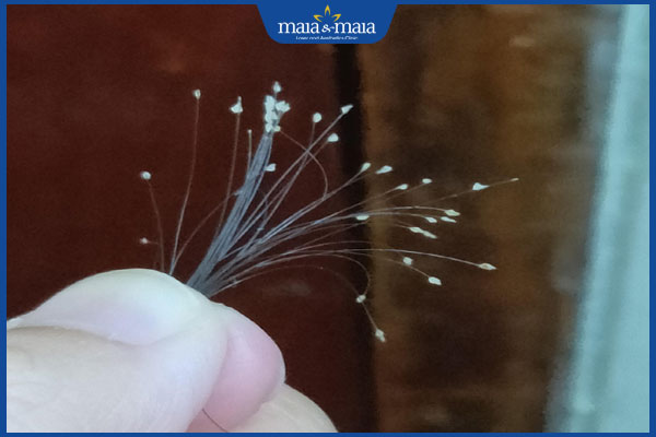 Tóc rụng có hạt trắng ở chân tóc có bình thường không? 2 hạt trắng ở chân tóc