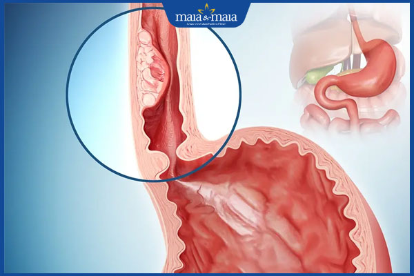 hẹp ống thực quản