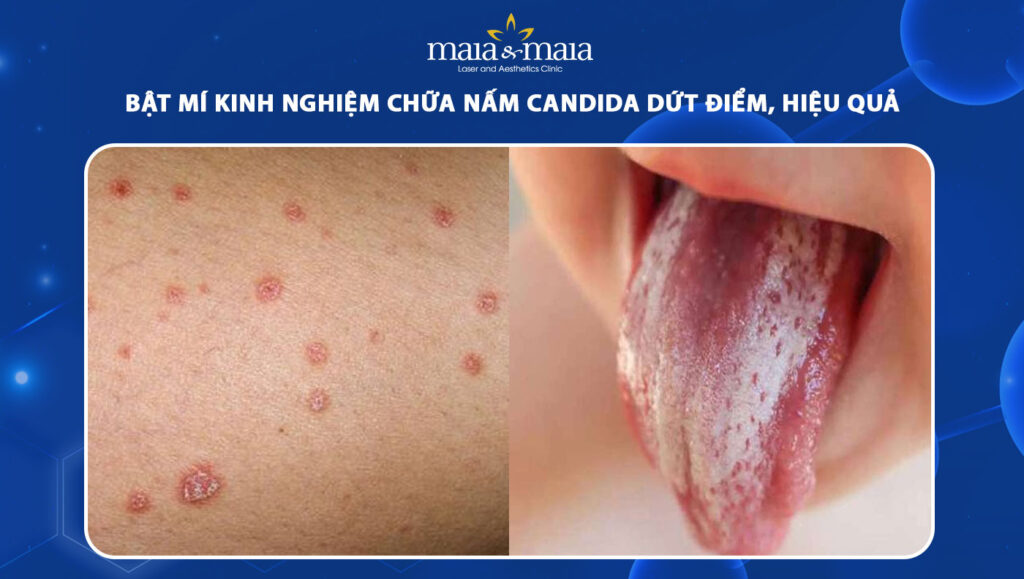 Bật mí kinh nghiệm chữa nấm Candida dứt điểm, hiệu quả 1 kinh nghiệm chữa nấm candida