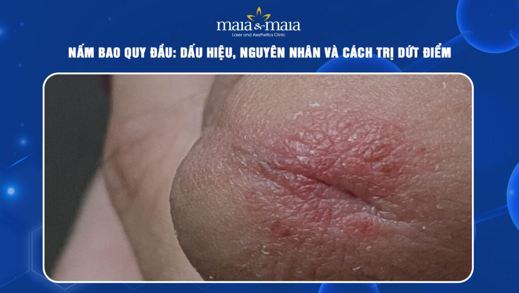 nấm bao quy đầu