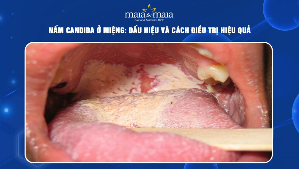 nấm candida ở miệng
