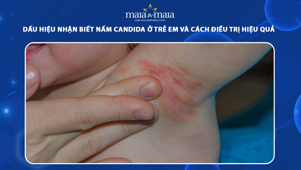 nấm candida ở trẻ em