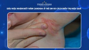 nấm candida ở trẻ em