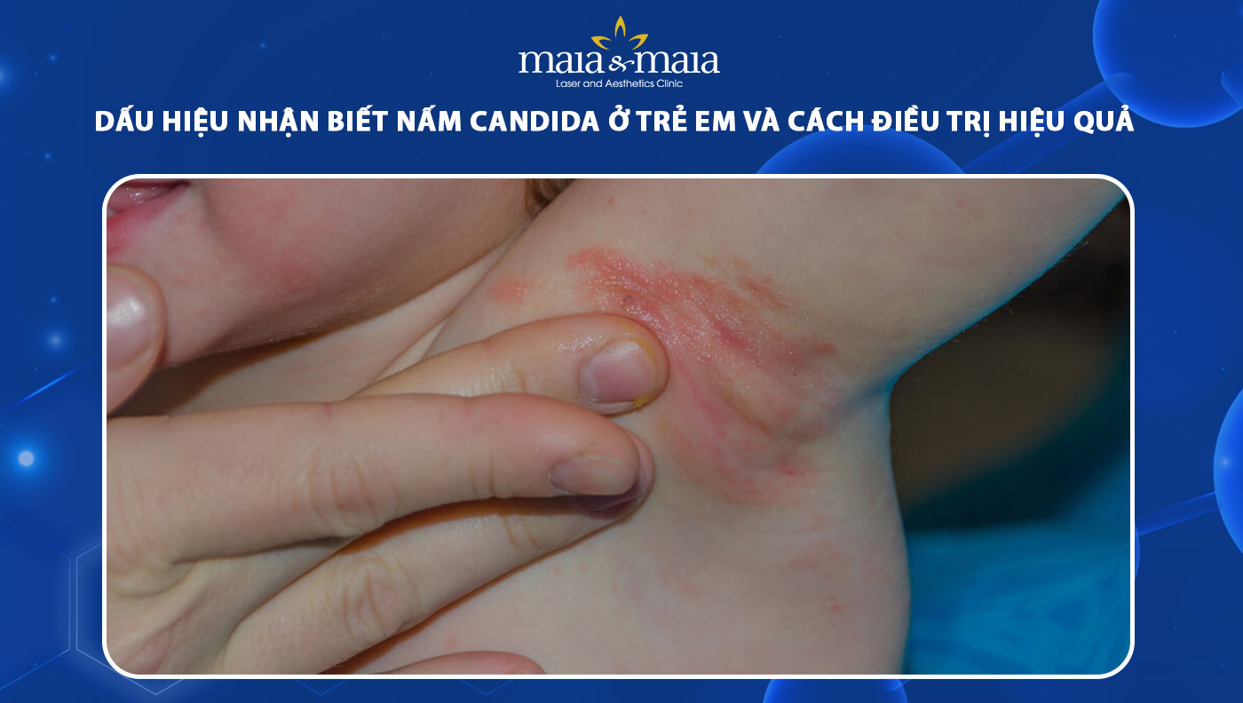 nấm candida ở trẻ em