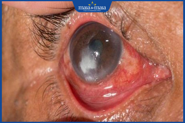 Bị nấm mắt có nguy hiểm không? Biện pháp phòng ngừa 2 nấm giác mạc