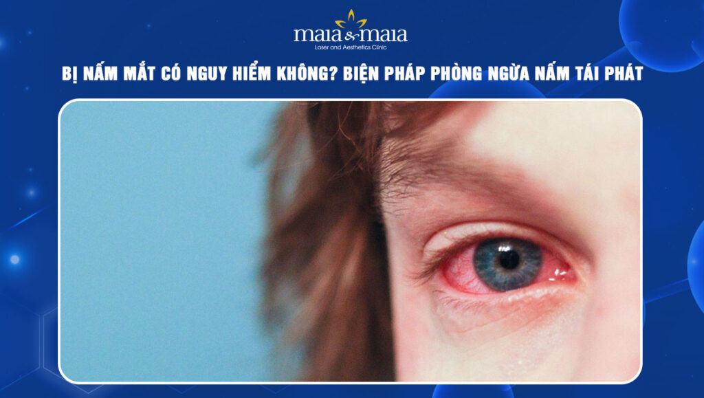 Bị nấm mắt có nguy hiểm không? Biện pháp phòng ngừa 1 nấm mắt