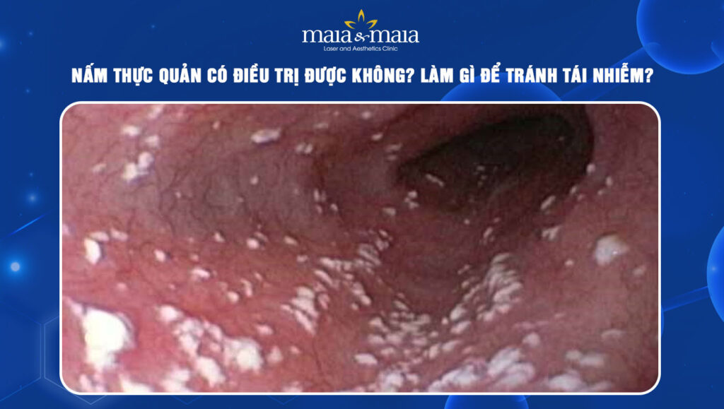 nấm thực quản