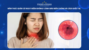 nấm thực quản có nguy hiểm không