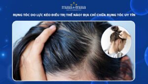 rụng tóc do lực kéo