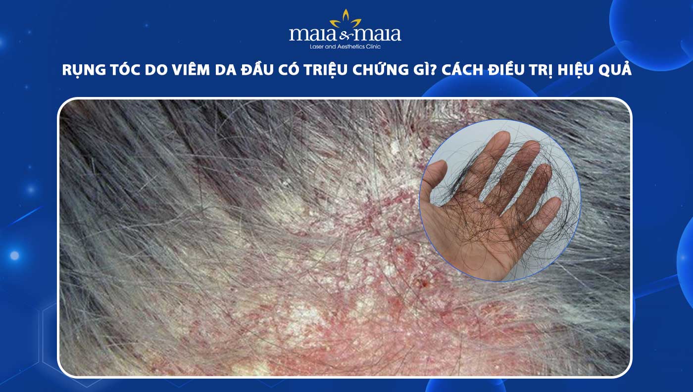 rụng tóc do viêm da đầu