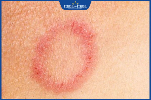 tình trạng hắc lào