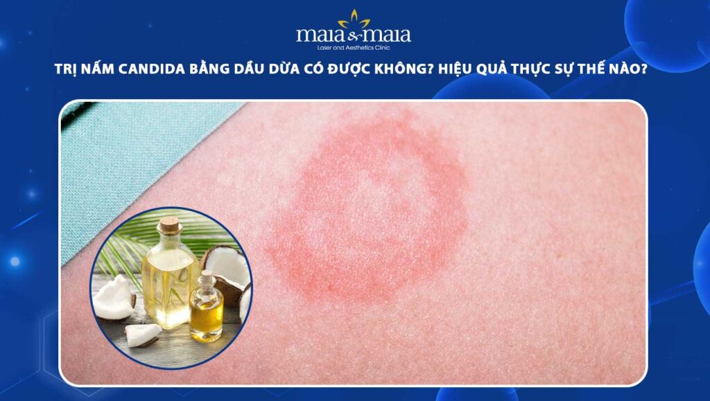 trị nấm candida bằng dầu dừa