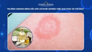 trị nấm candida bằng dầu dừa