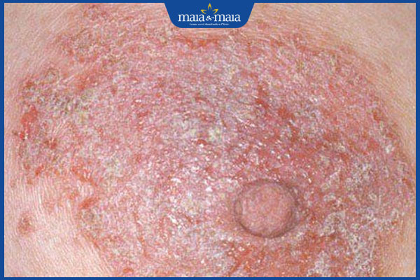 triệu chứng nấm đầu vú