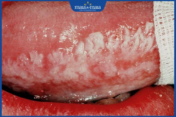 triệu chứng nấm họng hiv