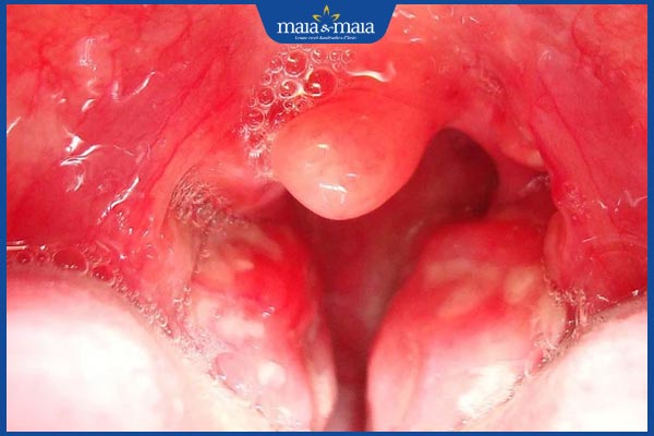 triệu chứng nấm thanh quản