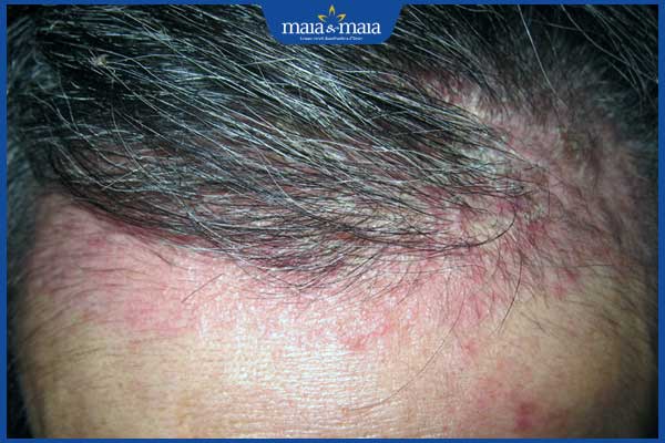 triệu chứng rụng tóc do viêm da đầu