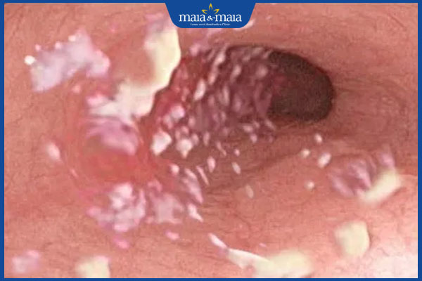 vi nấm ở thực quản