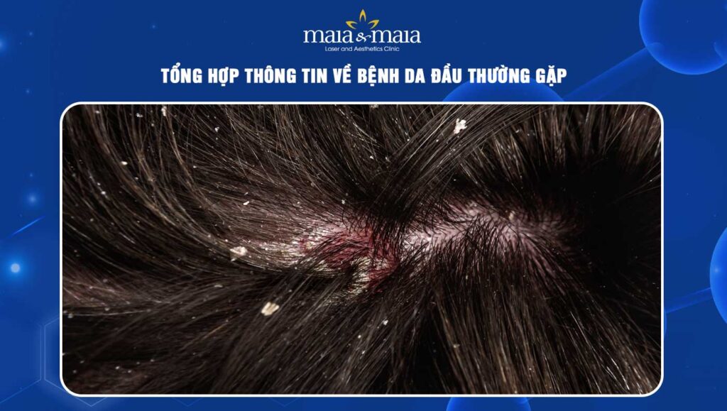 Tổng hợp về bệnh da đầu thường gặp và cách điều trị an toàn 1 bệnh da đầu