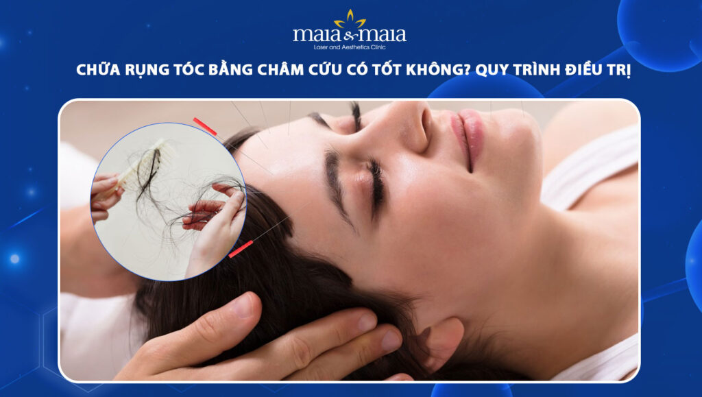 chữa rụng tóc bằng châm cứu