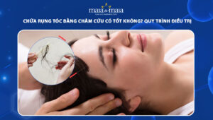 chữa rụng tóc bằng châm cứu