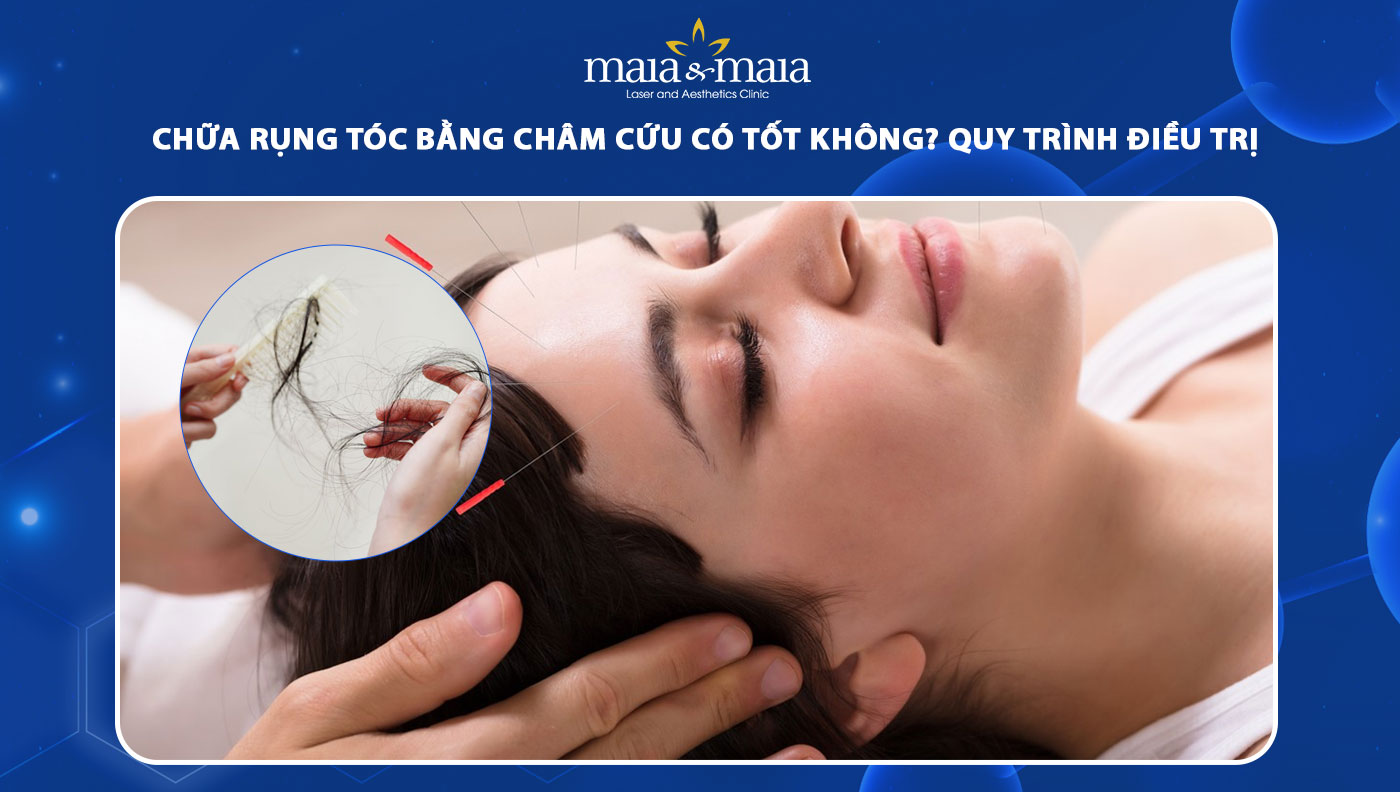 chữa rụng tóc bằng châm cứu