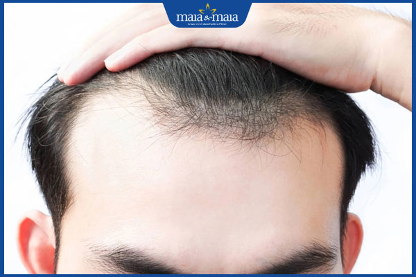 đặc điểm hói chữ M