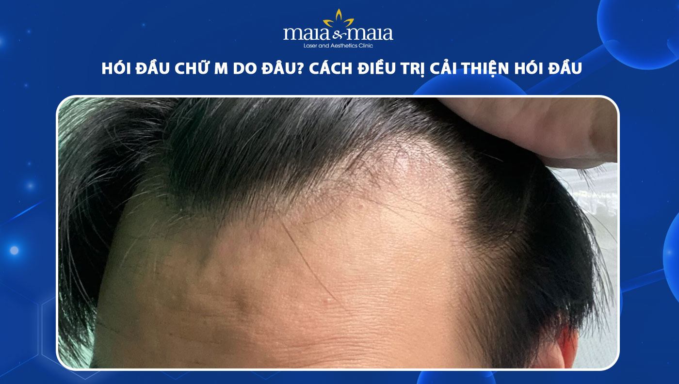 hói đầu chữ M