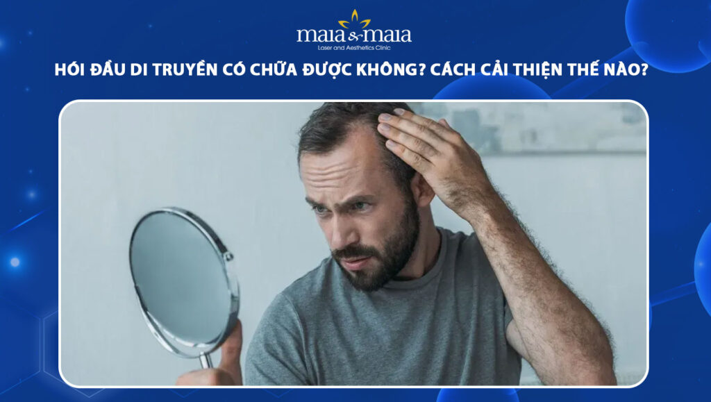 hói đầu di truyền có chữa được không