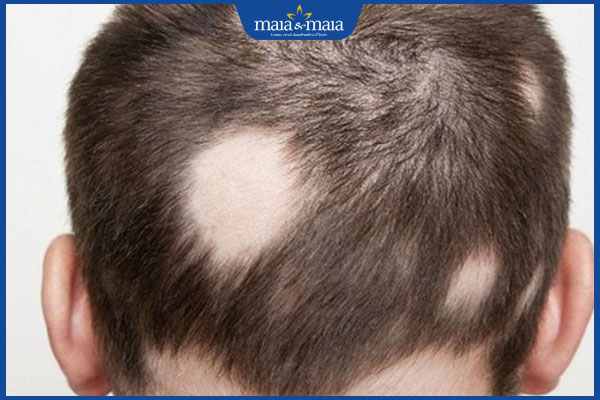 mất tóc để lại sẹo