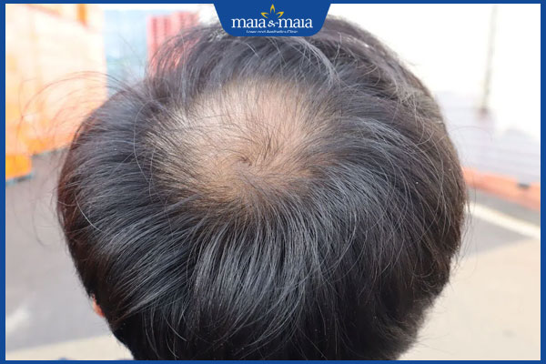 Bị rụng tóc ở đỉnh đầu do đâu? Giải pháp điều trị hiệu quả 2 nam giới rụng tóc ở đỉnh đầu