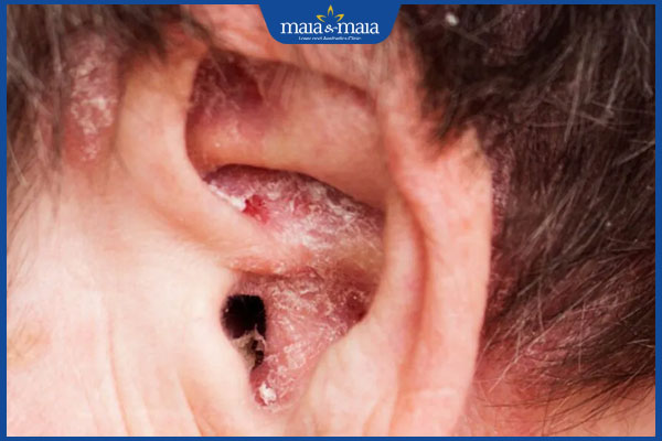 nấm ống tai ngoài