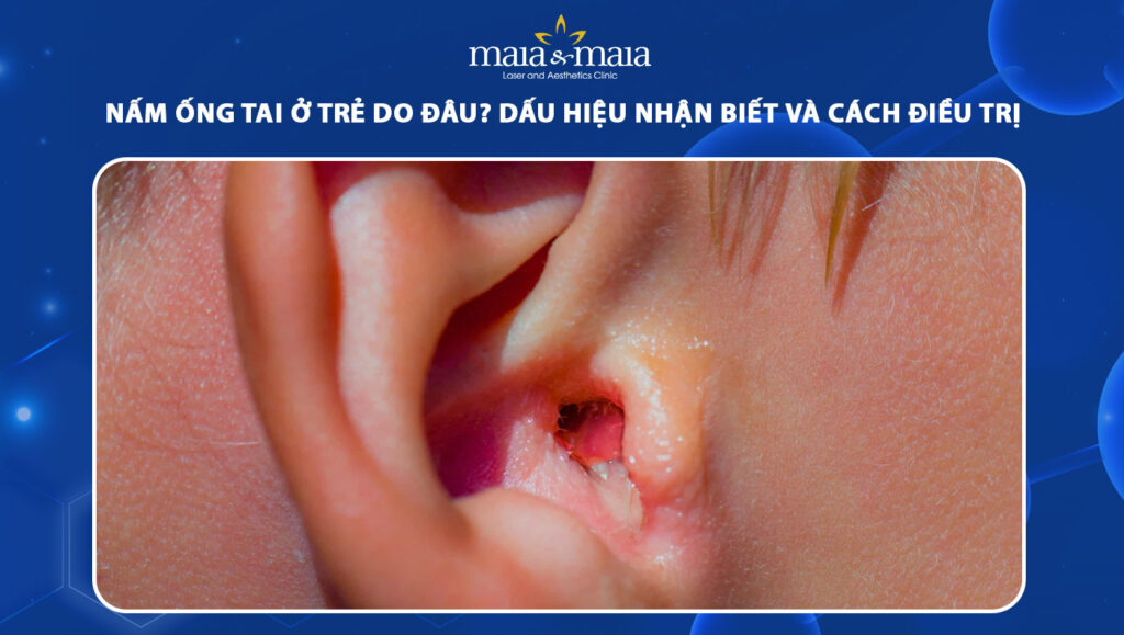 Nấm ống tai ở trẻ do đâu? Dấu hiệu và cách điều trị 1 nấm ống tai ở trẻ