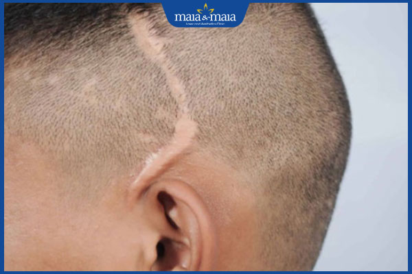 rụng tóc có sẹo thứ phát