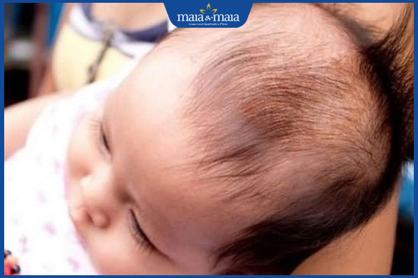 Bị rụng tóc ở đỉnh đầu do đâu? Giải pháp điều trị hiệu quả 3 rụng tóc đỉnh đầu ở trẻ nhỏ