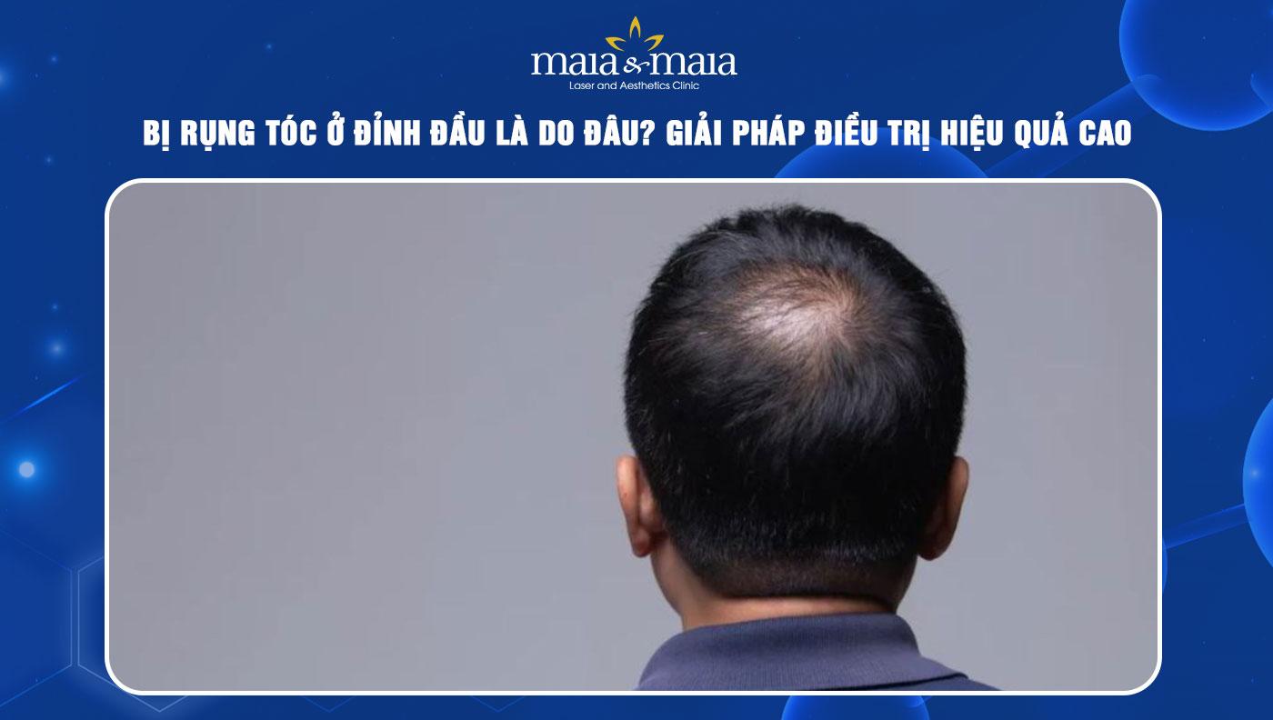 rụng tóc ở đỉnh đầu