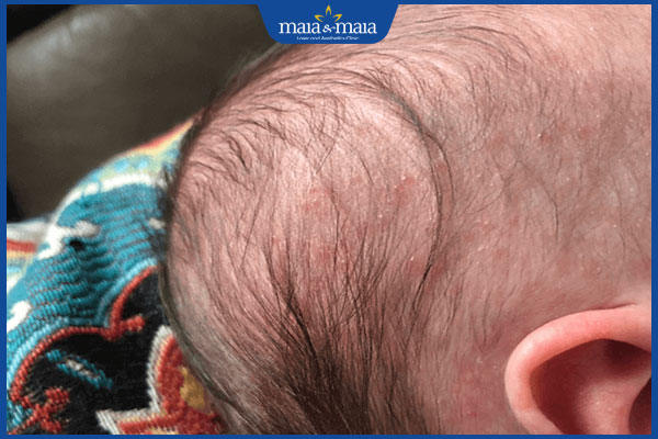 trẻ nhỏ bị viêm da đầu