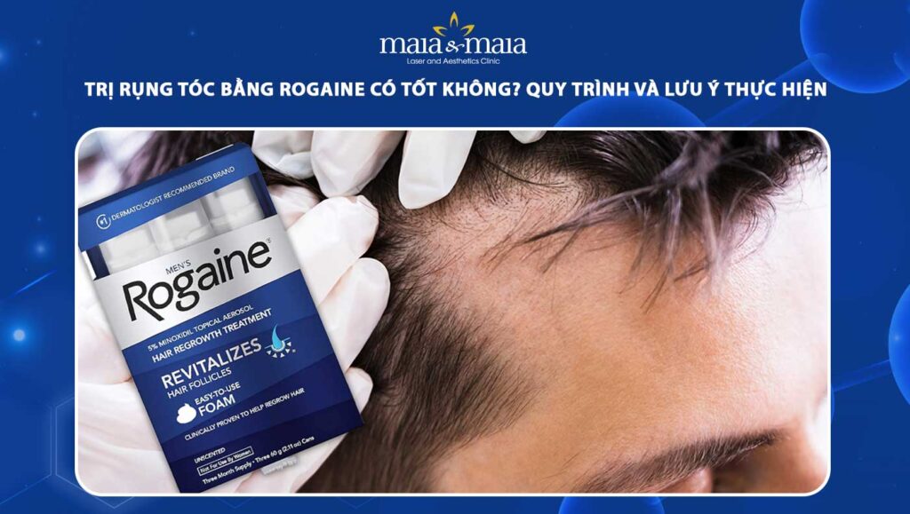 trị rụng tóc bằng rogaine