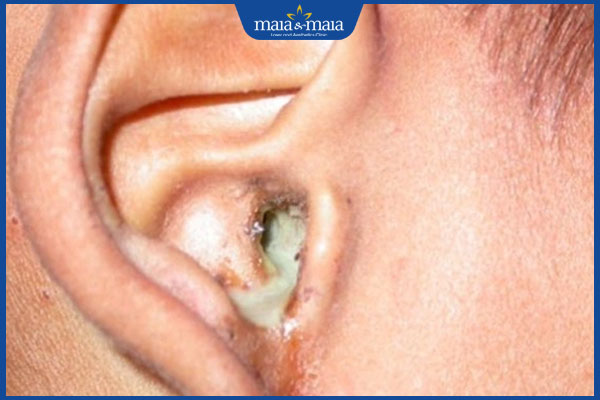 Nấm ống tai ở trẻ do đâu? Dấu hiệu và cách điều trị 2 triệu chứng nấm tai
