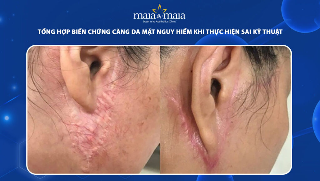 Biến chứng căng da mặt: Rủi ro cần biết trước khi thực hiện 1 biến chứng căng da mặt
