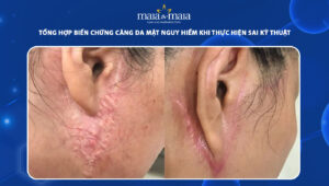 biến chứng căng da mặt