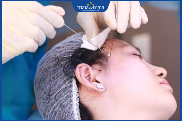 Biến chứng căng da mặt: Rủi ro cần biết trước khi thực hiện 2 biểu hiện sau căng da mặt