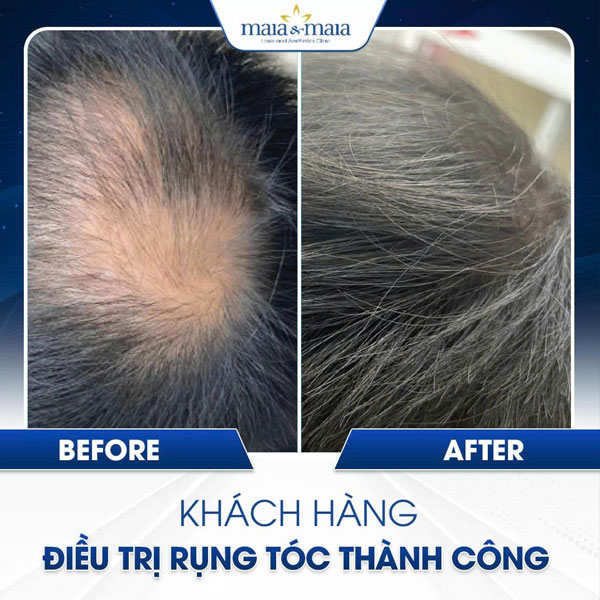 cải thiện mật độ tóc tại maia